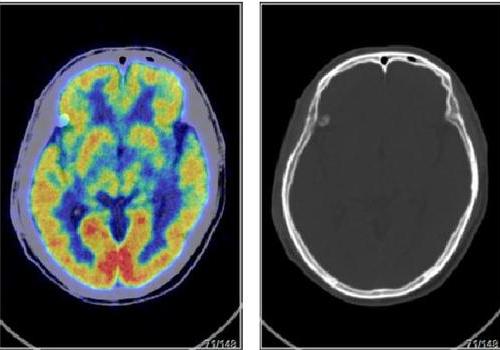 癌症筛查，做PETCT检查案例-全国PETCT/MR检查预约网-癌症筛查-肿瘤复查-高端体检